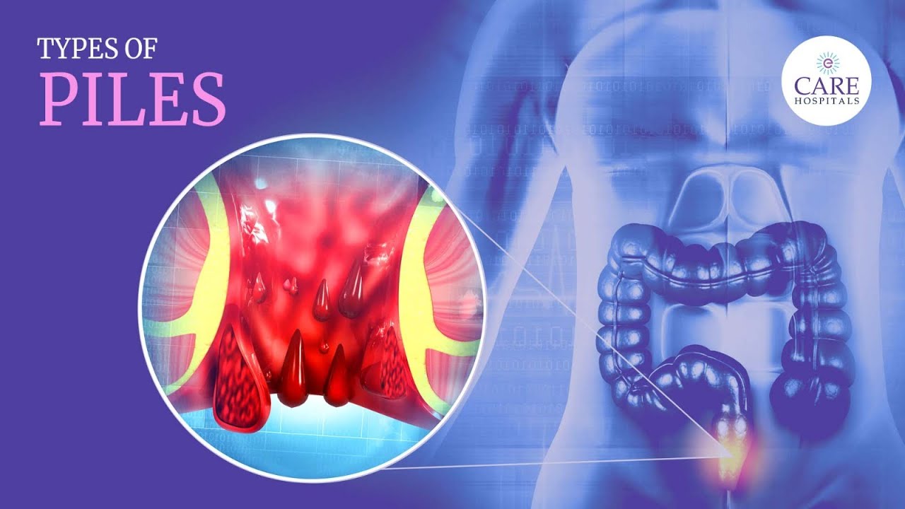What are Hemorrhoids(Piles) | What are the Types of Piles | How to Diagnose Piles?| बवासीर