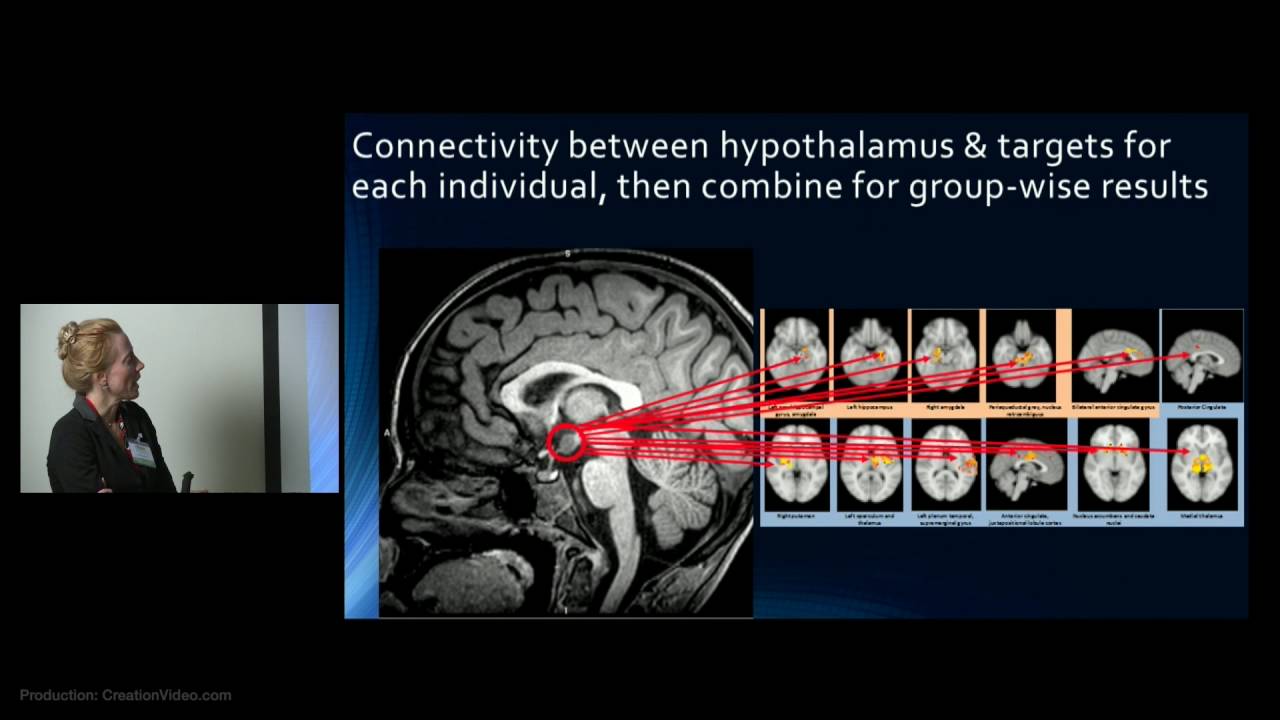Hypothalamic Hamartoma: Imaging Use in Diagnosis & Management by Varina Boerwinkle