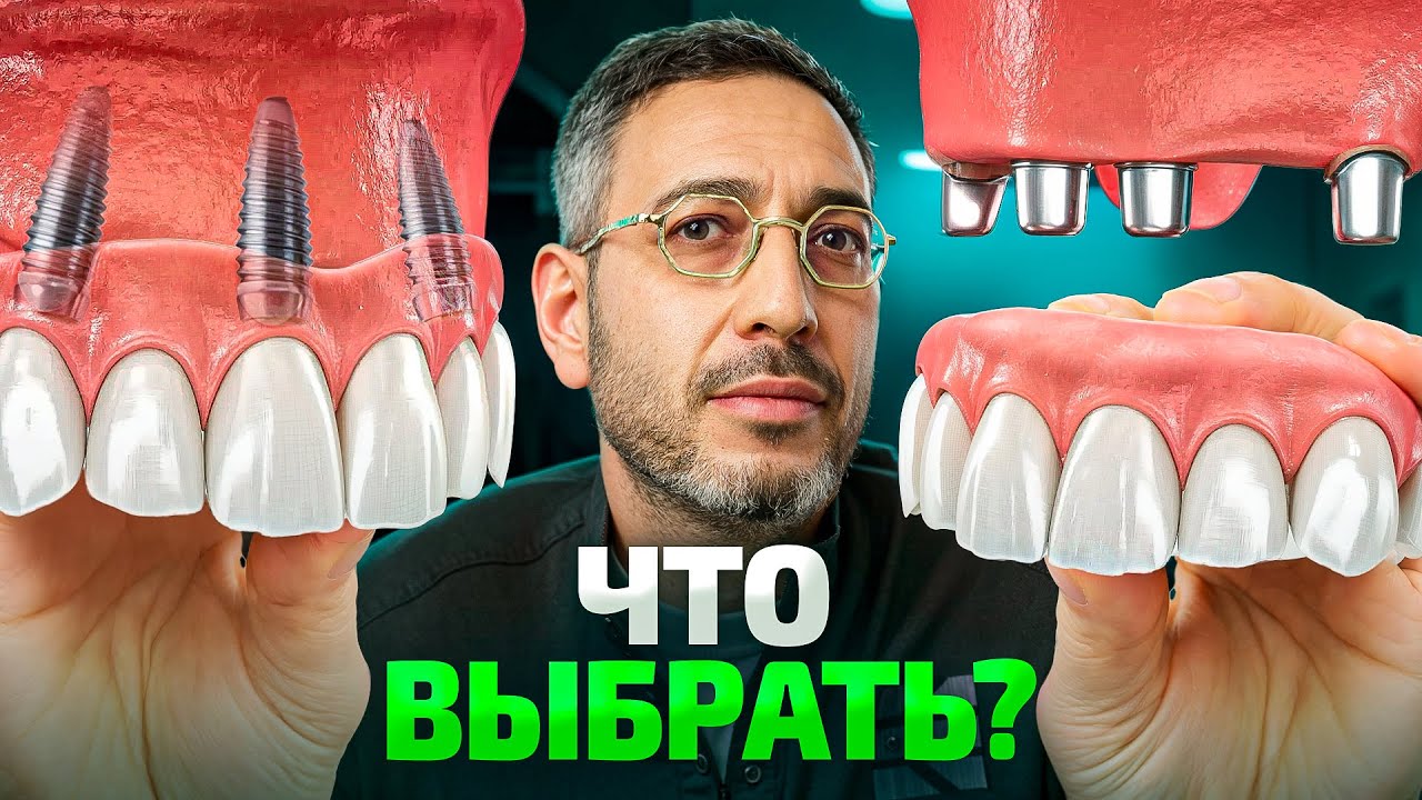 Альтернатива зубным имплантам, что можно выбрать в 2026?