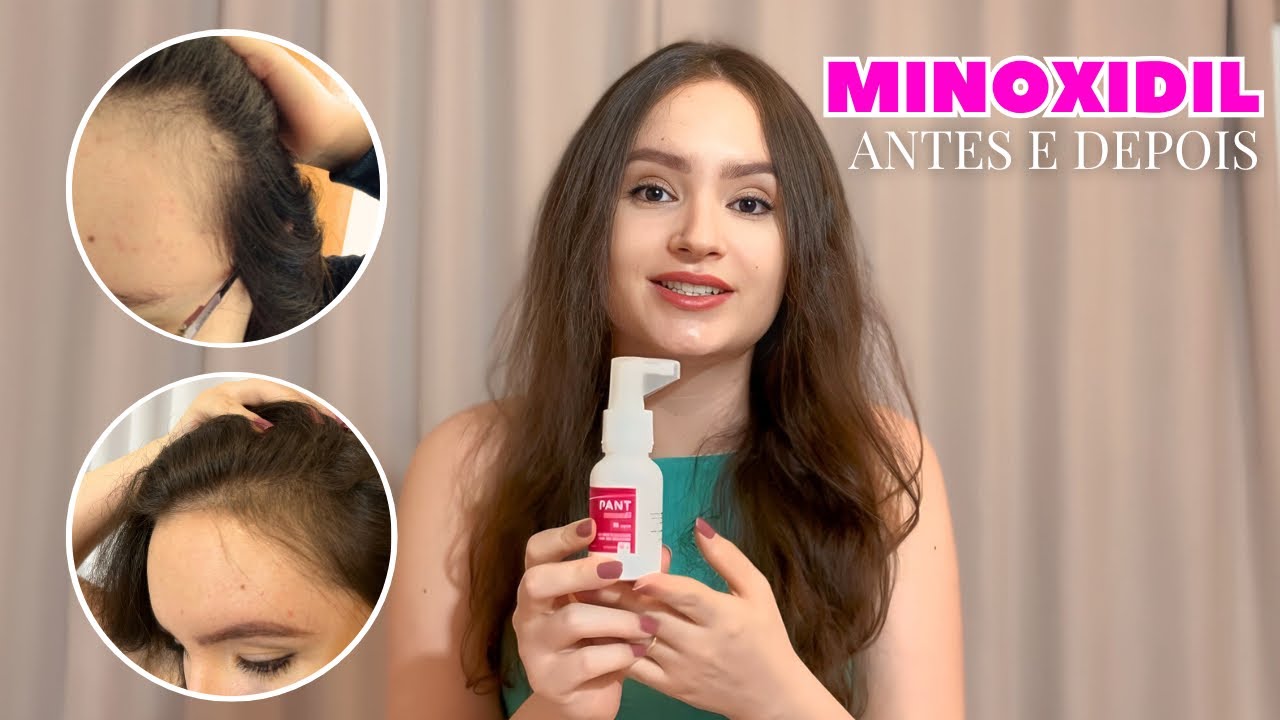 MINOXIDIL - minha experiência completa ao longo de 1 ano de uso