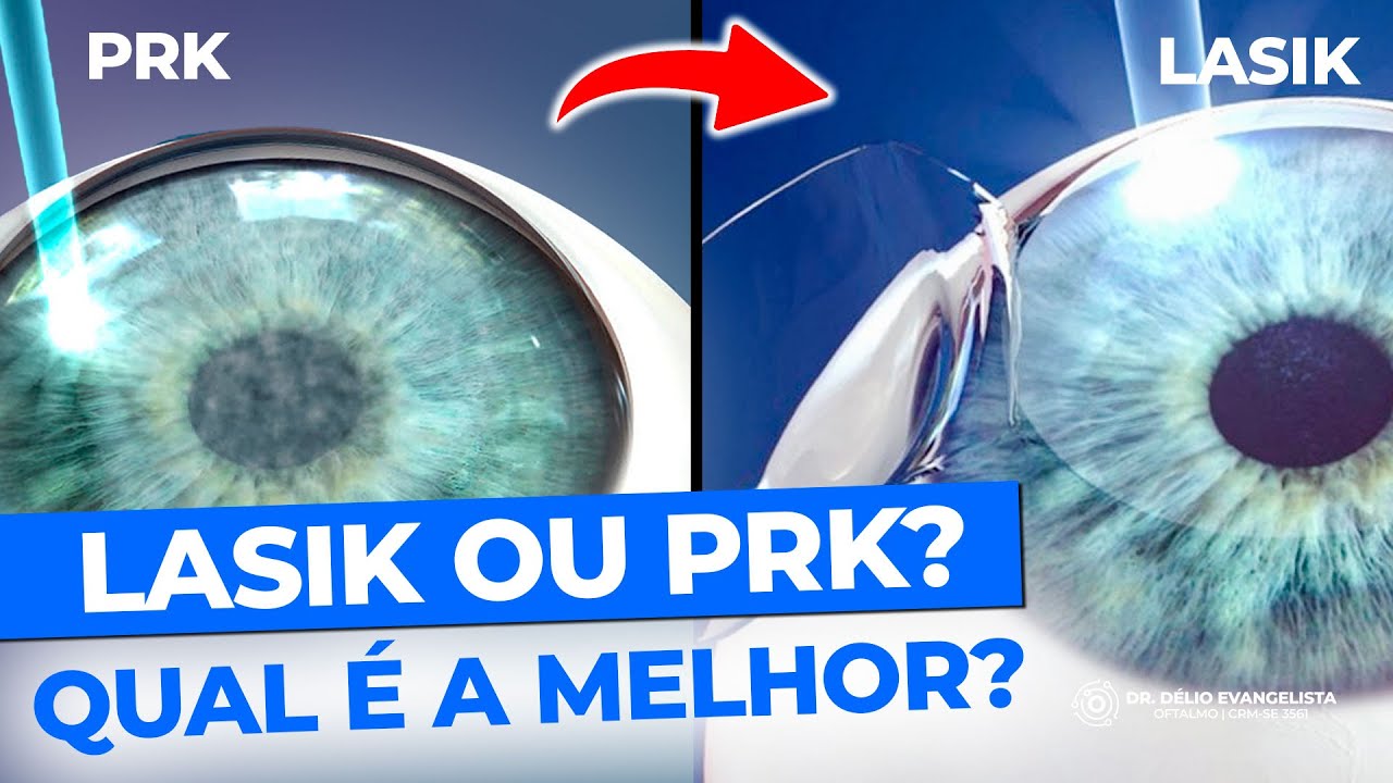 Qual é a melhor Cirurgia Refrativa? LASIK ou PRK?