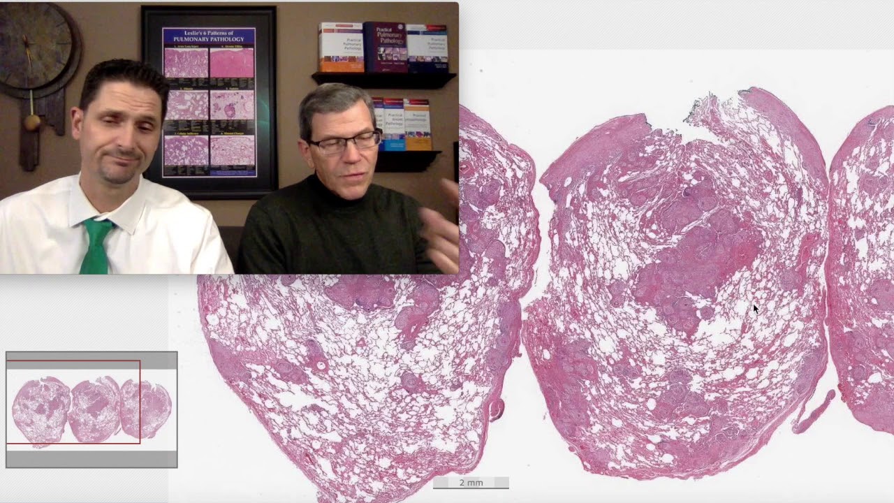 Pattern 2 – Fibrosis, Pulmonary Sarcoidosis (Top 25 Pearls Series, Topic 6, Pearl 3)
