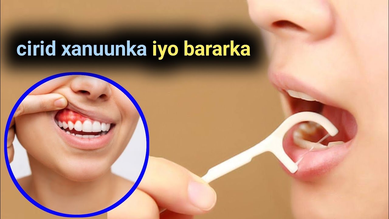 Cirid xanuunka , cirid bararka iyo cirid dhiiga