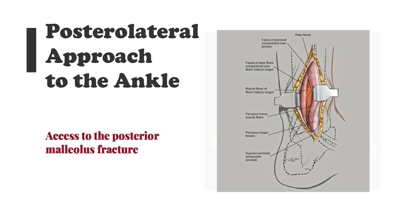 Posterolateral Approach to the Ankle.