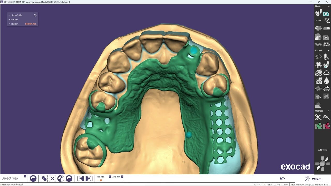 RPD (exocad)