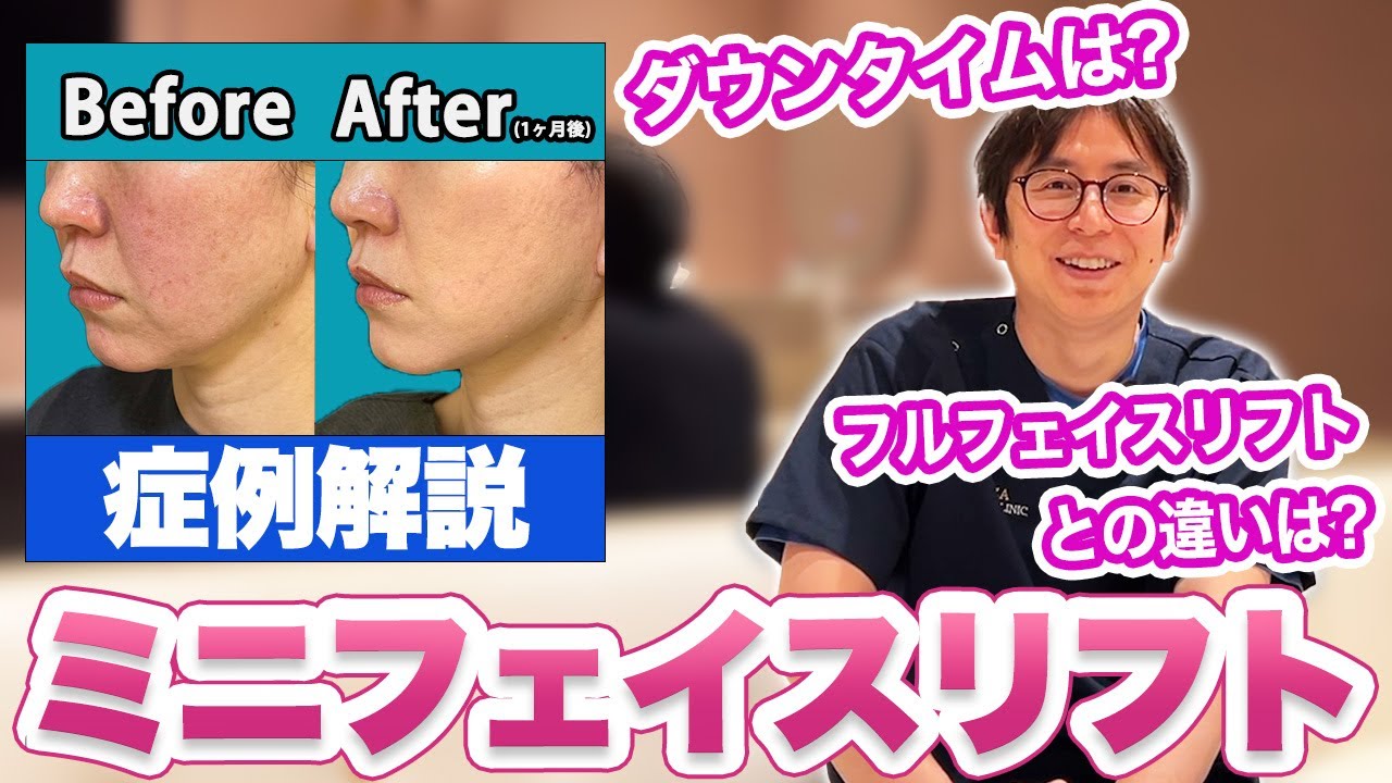 【ミニフェイスリフト】マイナス10歳若返る!?今人気の施術を徹底解説!