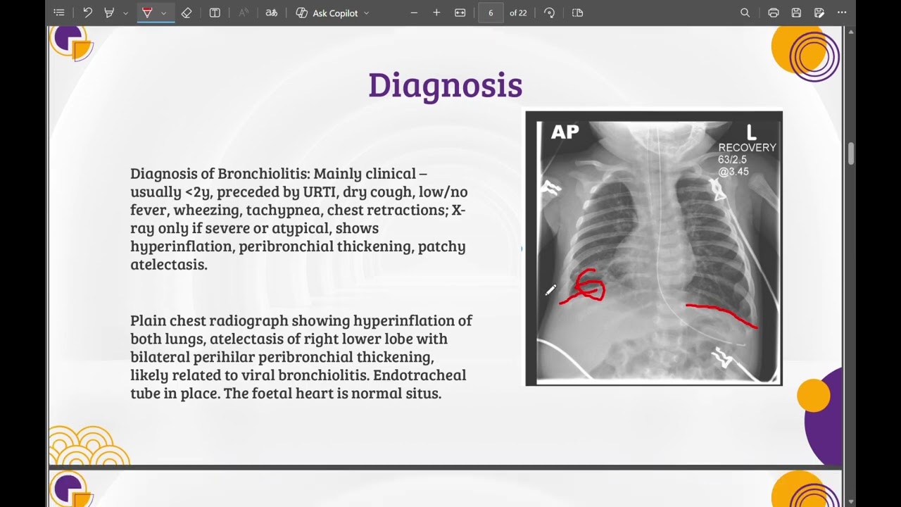paediatric lecture 2 bronchiolitis اطفال