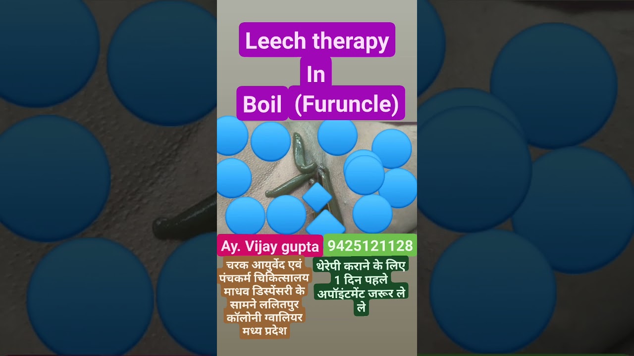 leech therapy in boil
