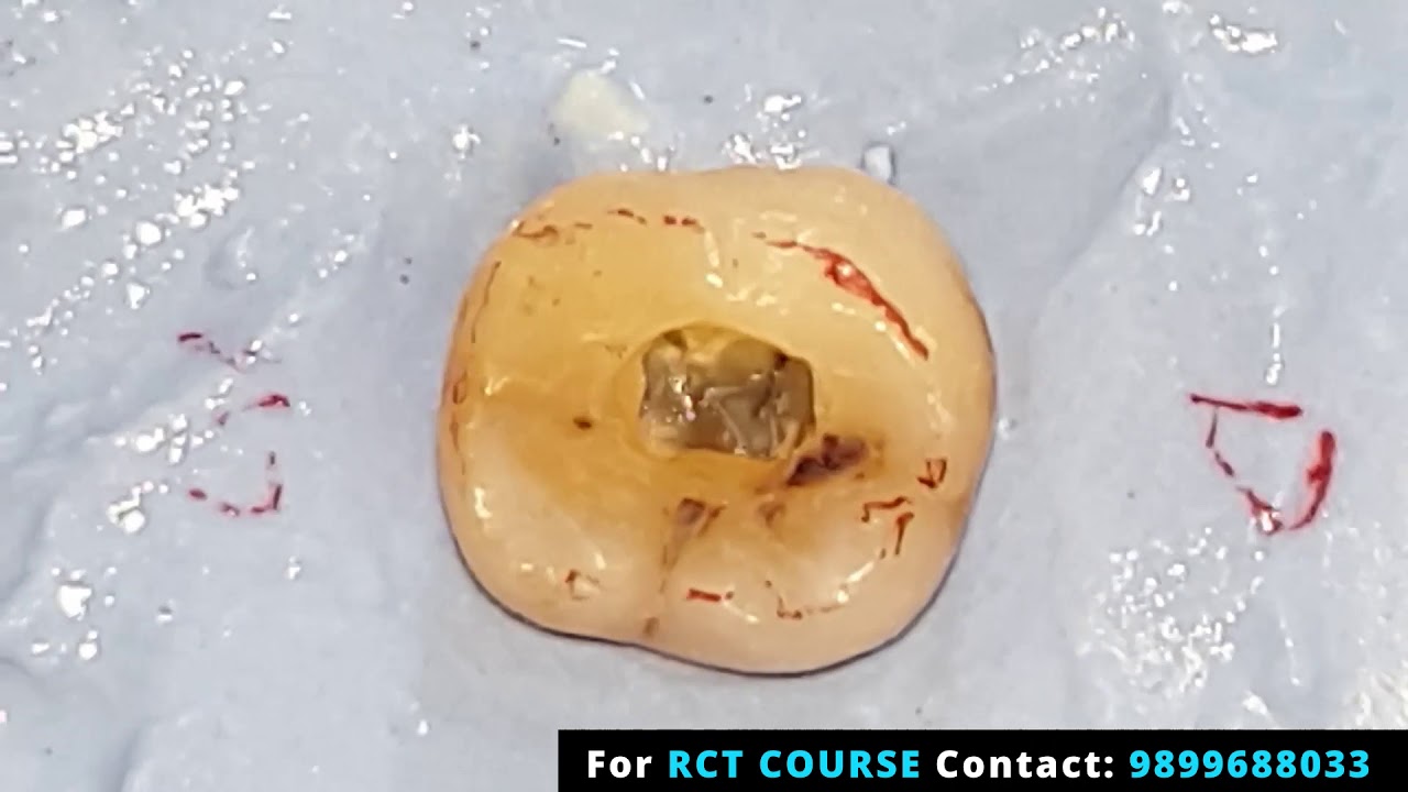 Endo Access Preparation - Mandibular First Molar- Live Demo General Dentistry Course- Root Canal
