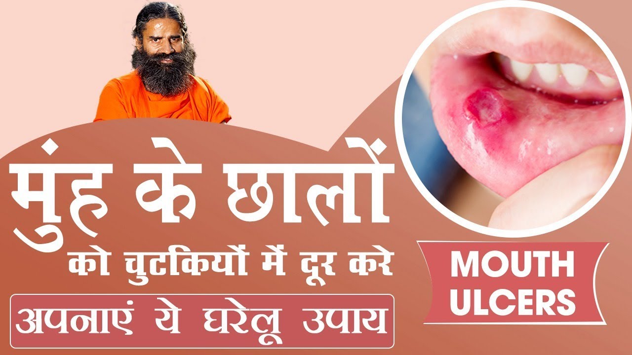 मुंह के छालों (Mouth ulcers) को चुटकियों में दूर करे अपनाएं ये घरेलू उपाय | Swami Ramdev