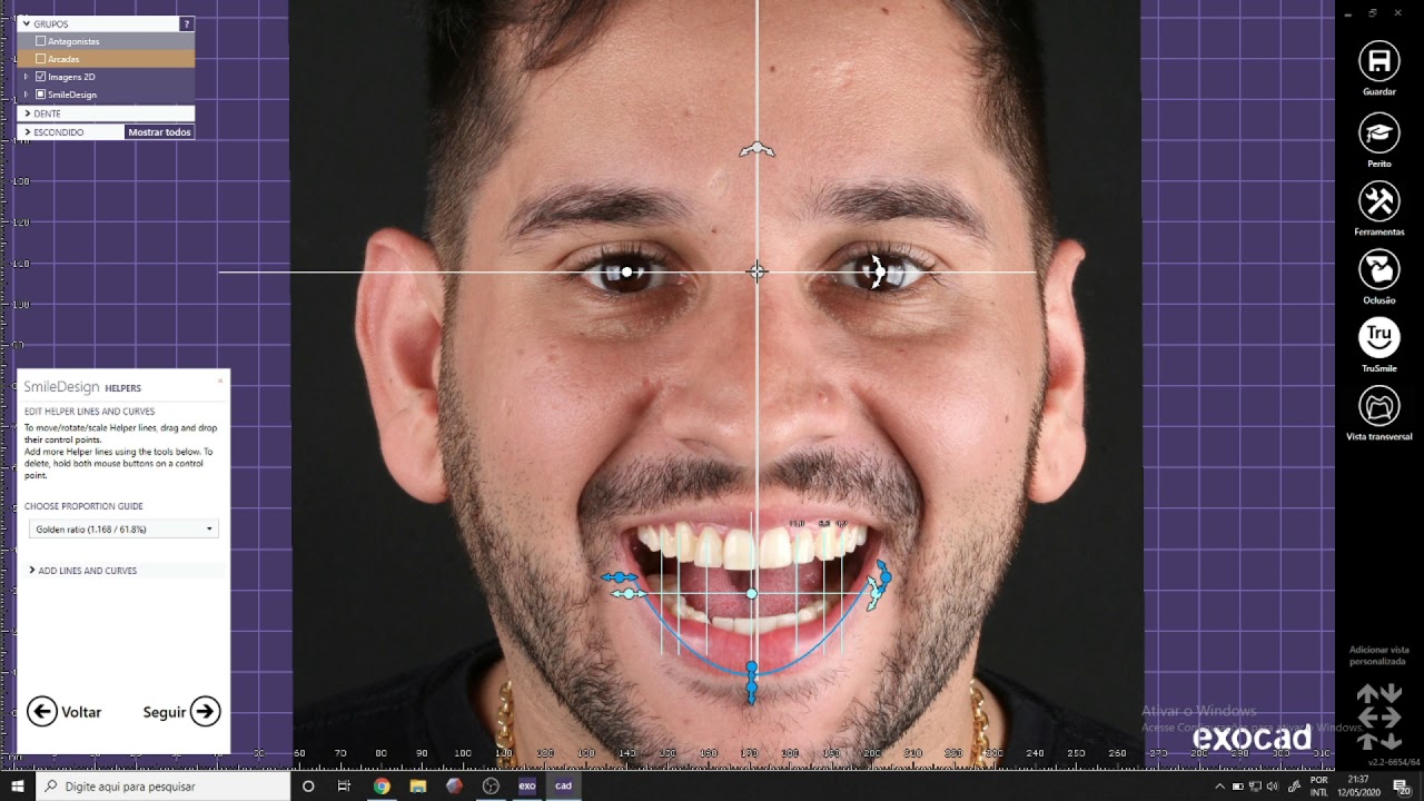 Planejamento / Enceramento Diagnóstico Avançado (com Foto e Articulador Virtual) Parte 1 (ExoCad)