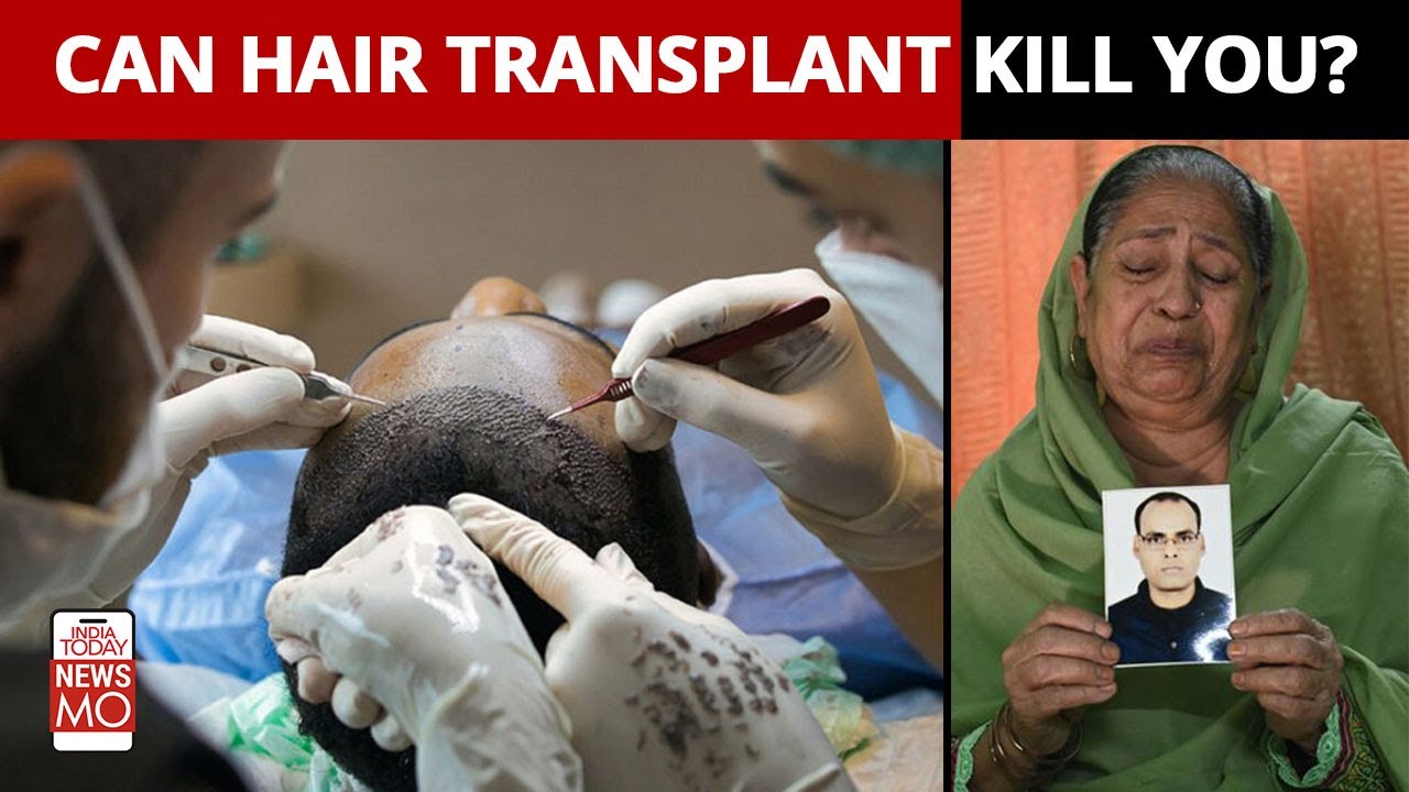 Can You Die Of Hair Transplant Surgery? Doctors Explain