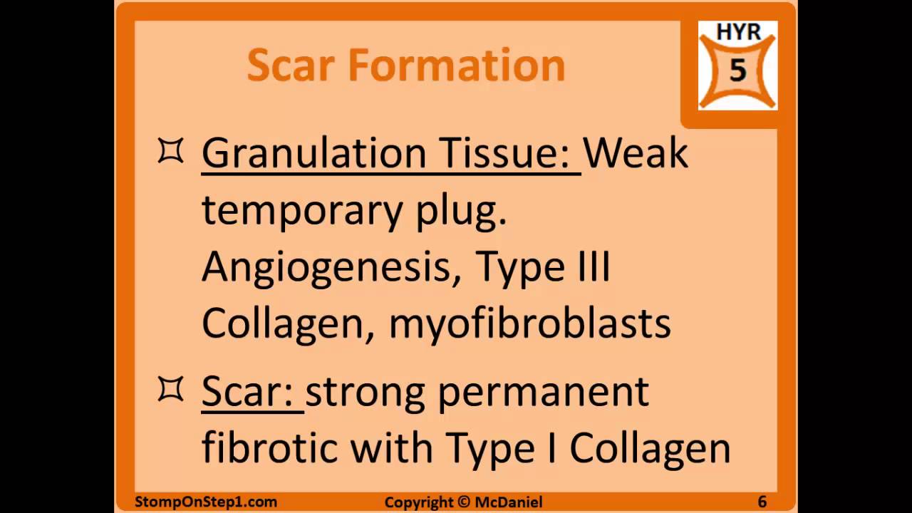 Complement System, Granulomas, Exudate Granulation Tissue C5a multinucleated giant cells