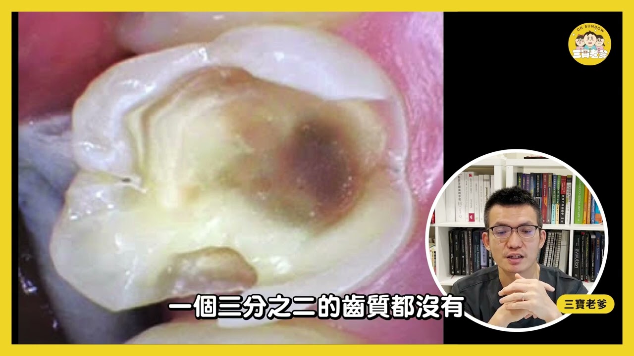 預防蛀牙秘密，顯微鏡補牙治療！三寶牙醫吳國源醫師活髓保存術，水雷射顯微微創新趨勢