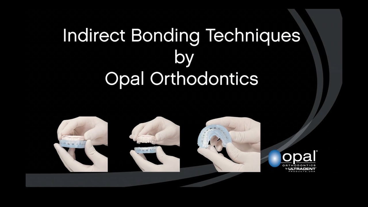 Indirect Bonding by Opal Orthodontics
