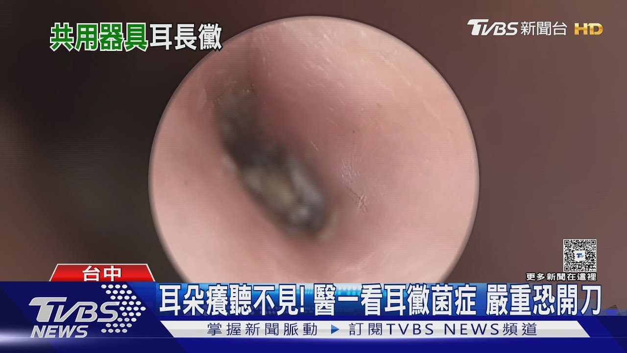 疑瘋洗越式洗頭「采耳」 男子耳朵長黴菌求助醫｜TVBS新聞 @TVBSNEWS02
