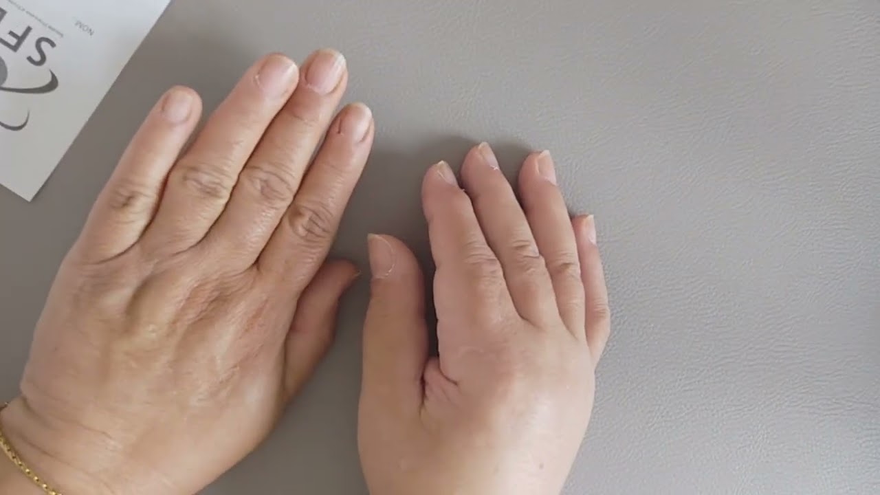 Diagnostic de l'algodystrophie : présentation des critères de Budapest