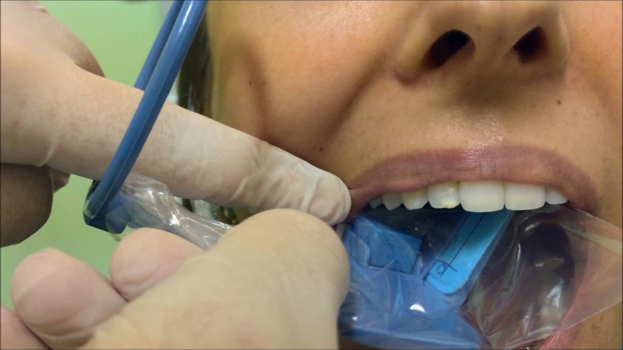 Radiografia Periapical com Posicionadores - Maxila Posterior