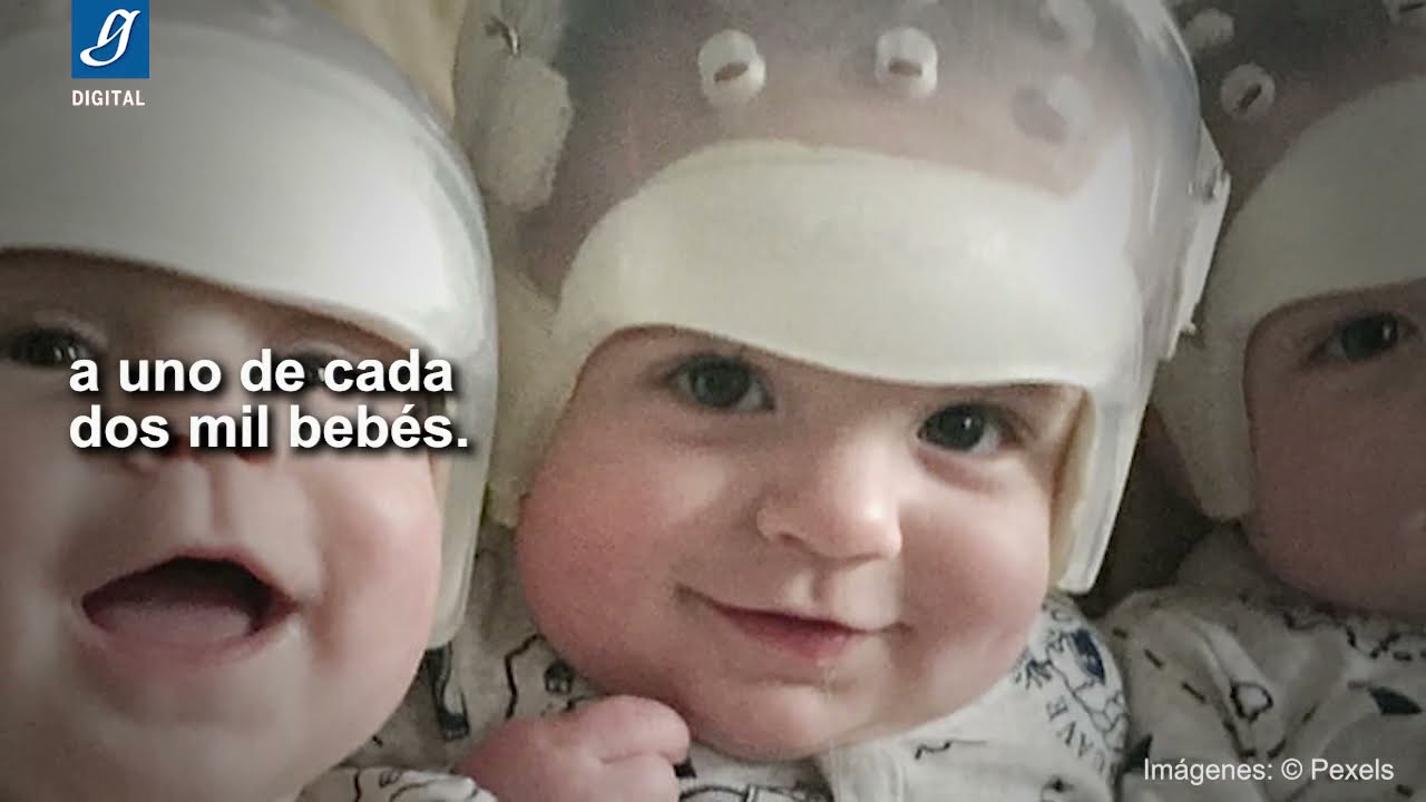 Una extraña enfermedad: el cráneo se deforma porque las suturas se cierran prematuramente