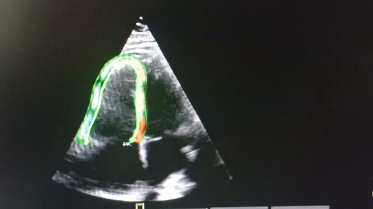 2D Speckle Tracking Strain of RV in patient post Fibrinolytic Acute Pulmonary Embolism 