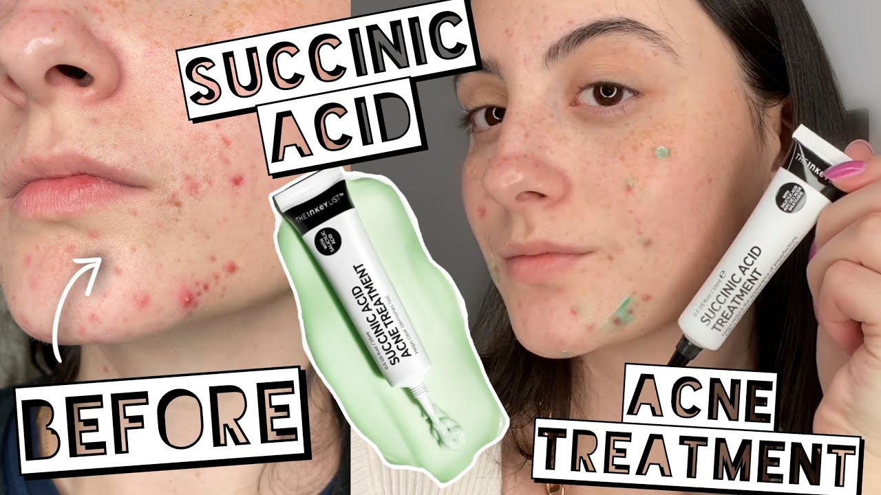 BEST NEW ACNE TREATMENT | TESTING THE INKEY LIST SUCCINIC ACID ON MY ACNE FOR 2 WEEKS