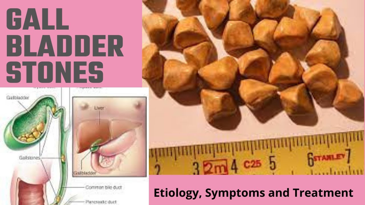 Gall bladder stones - Etiology, Symptoms, Treatment and Complications
