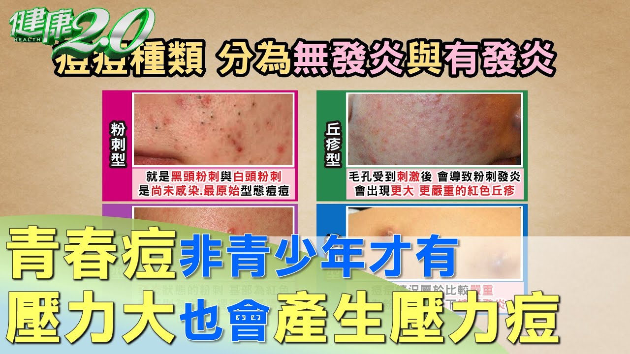 青春痘非青少年的專利 壓力大也會產生壓力痘 健康2.0