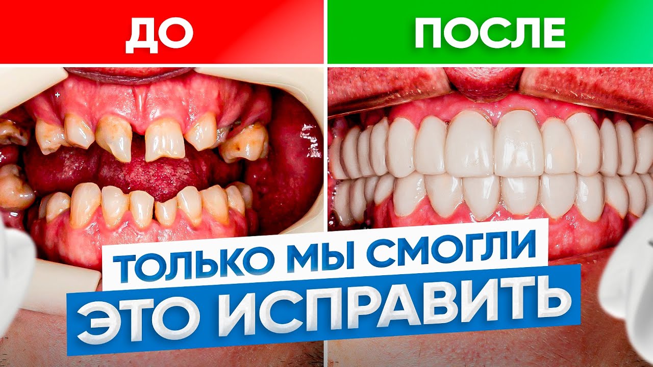 Их взяли только мы! Очень кривые зубы – ДО/ПОСЛЕ. Исправление прикуса брекетами
