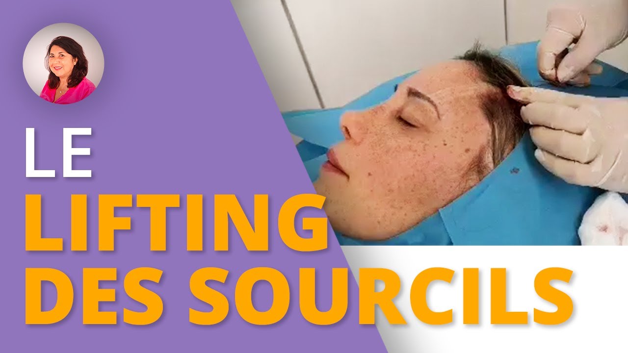 Lifting des sourcils par fils tenseurs à Capbreton