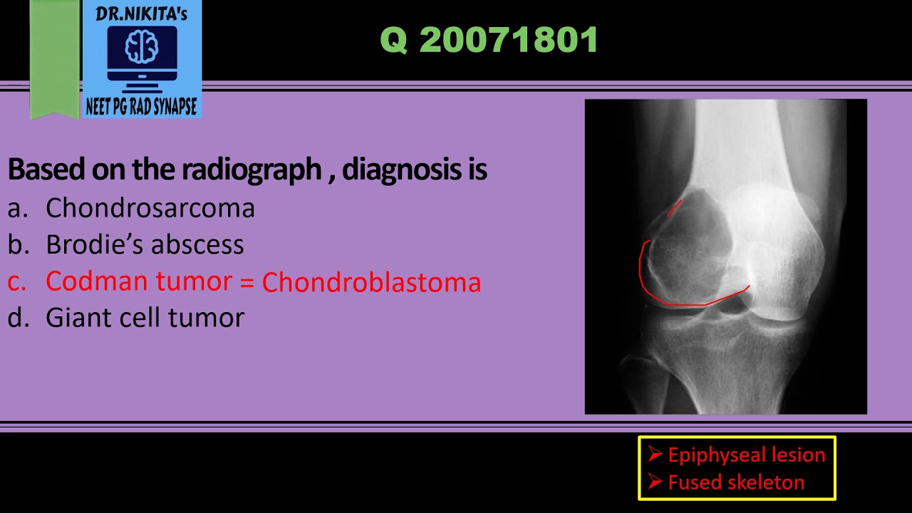 Differentiating epiphyseal lesions- Chondroblastoma vs Giant cell tumor