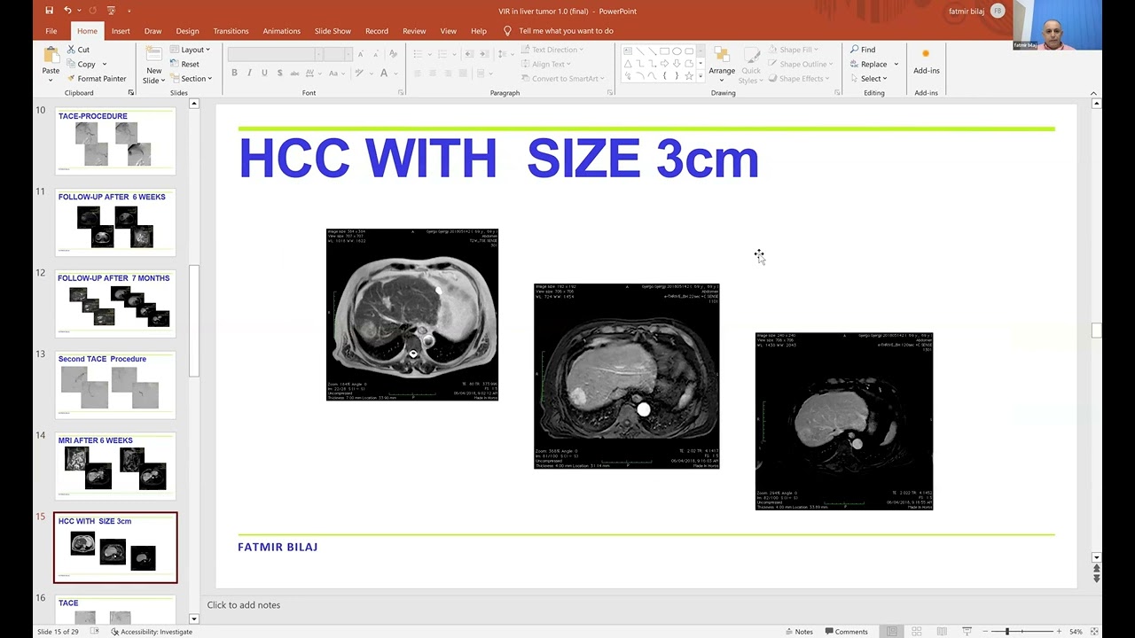 23.15) Radiologia interventistica in ambito oncologico - Prof. Venturini e Prof. Belaj