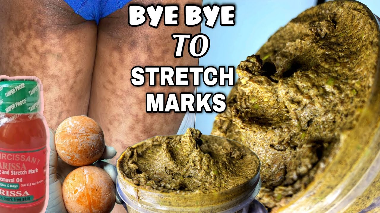 STRETCH MARK TREATMENT SOAP🌿 | HOW TO CLEAR STRETCH IN 2 WEEKS | SCAR & STRETCH MARKS REMEDY #soap