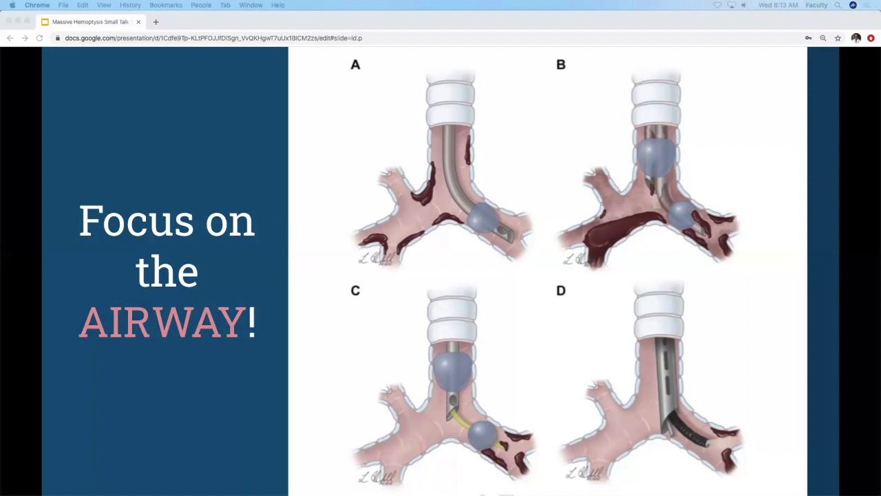Dr  Warshaw   Massive Hemoptysis