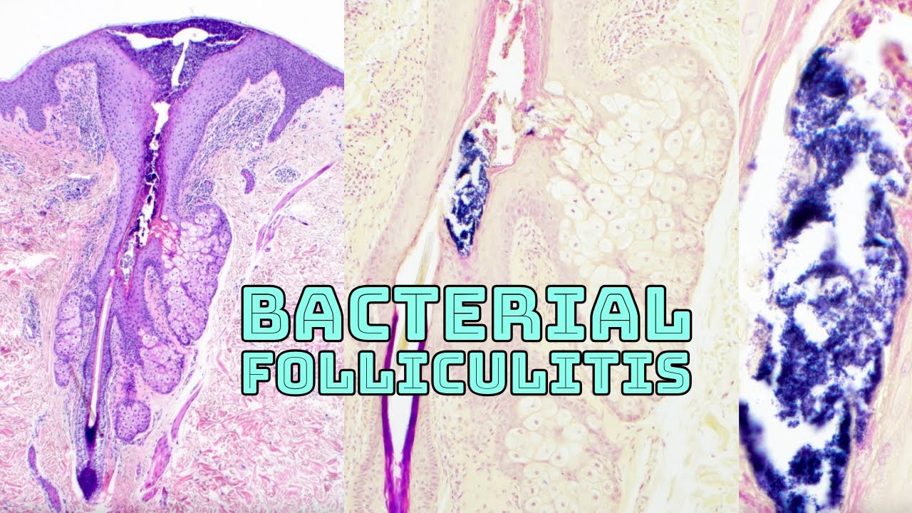 Bacterial folliculitis under microscope (inflamed hair follicle w/ Gram positive cocci) histology