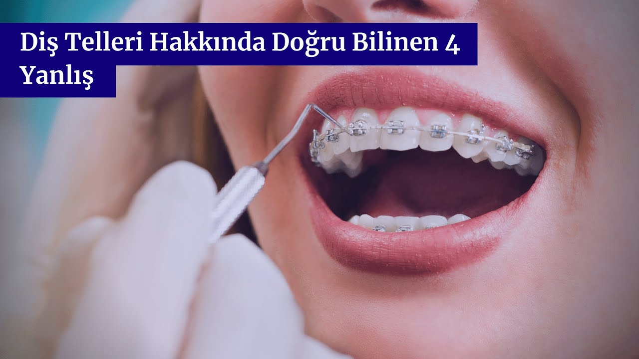 Diş Telleri Hakkında Doğru Bilinen 4 Yanlış