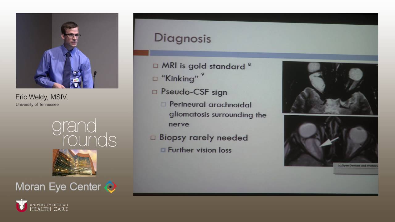 Proptosis and Insidious Vision Loss in a Pediatric Patient