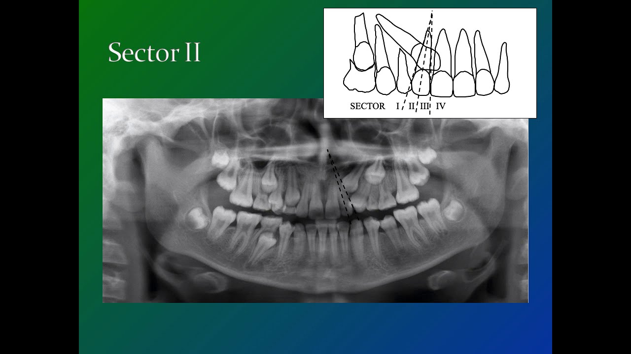 Impacted Canines