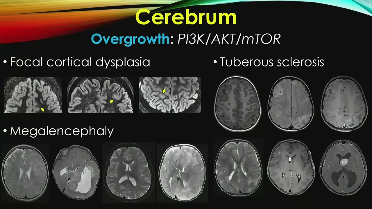 Pediatric Brain: Tumor & Mimics