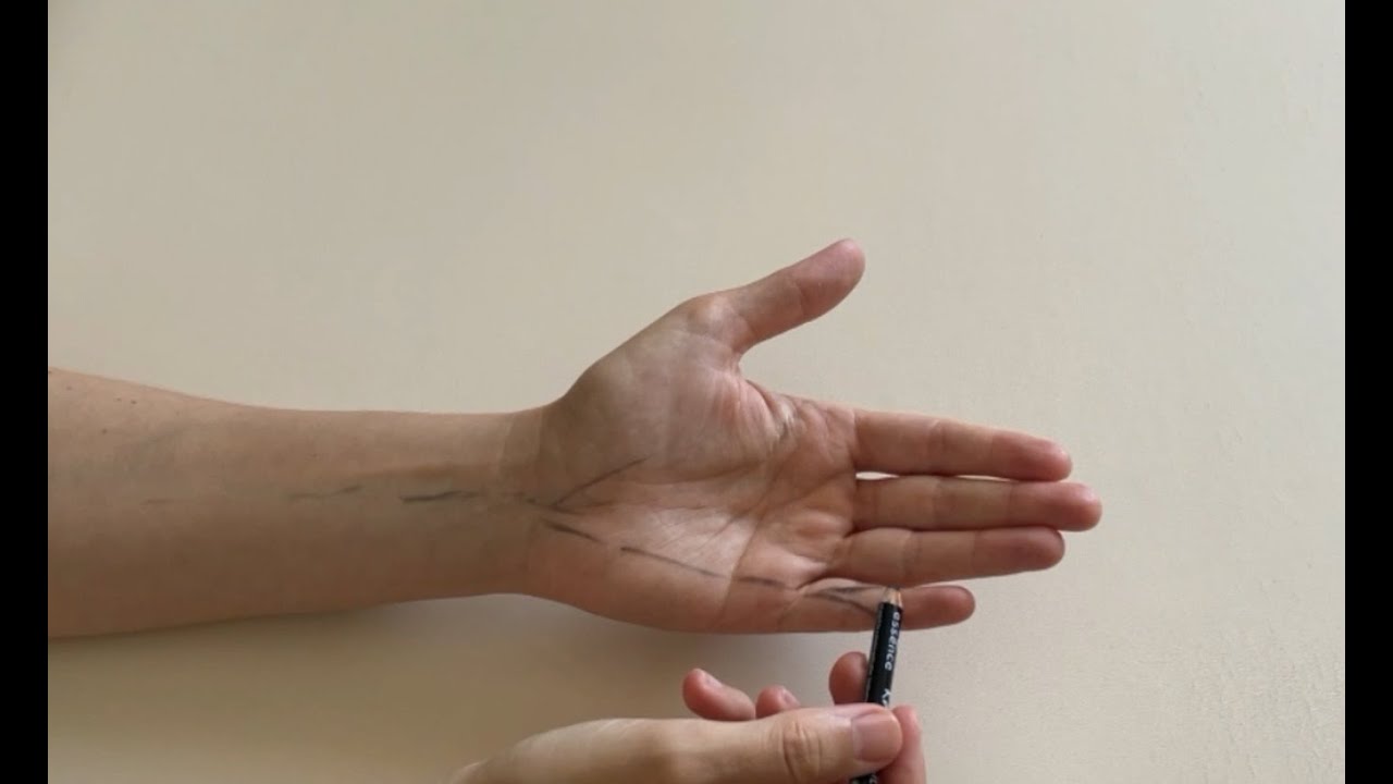Morbus Dupuytren - Zusammenhang zwischen Hand und Unterarm