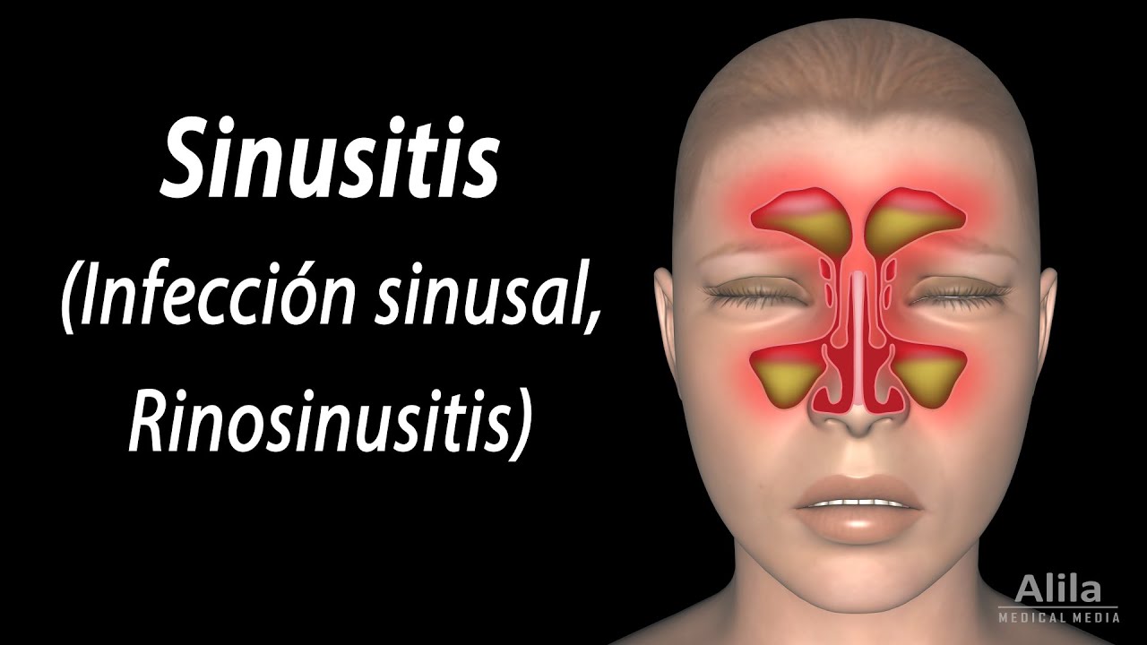 Sinusitis, Animación. Alila Medical Media Español.