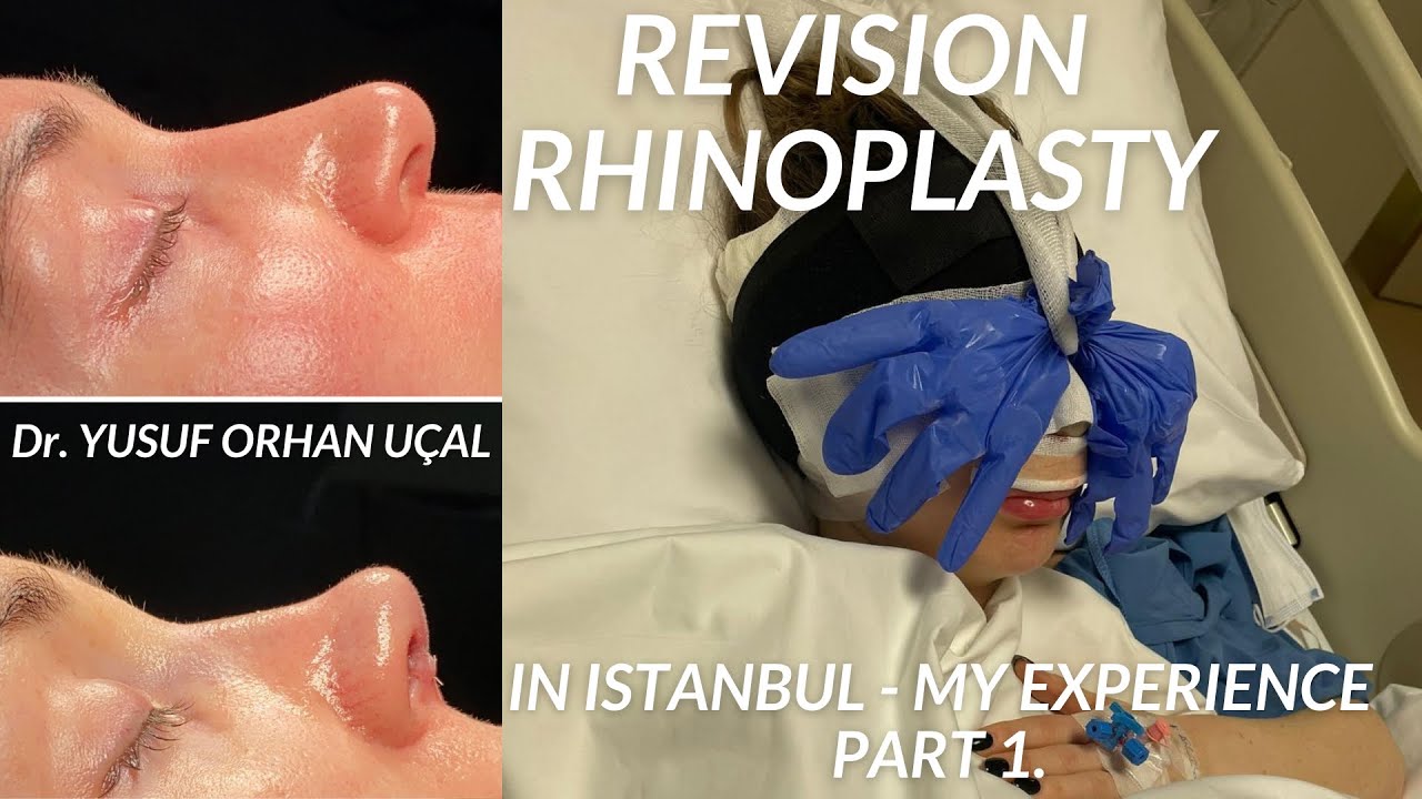 MY REVISION RHINOPLASTY EXPERIENCE IN ISTANBUL - PART 1. VLOG.