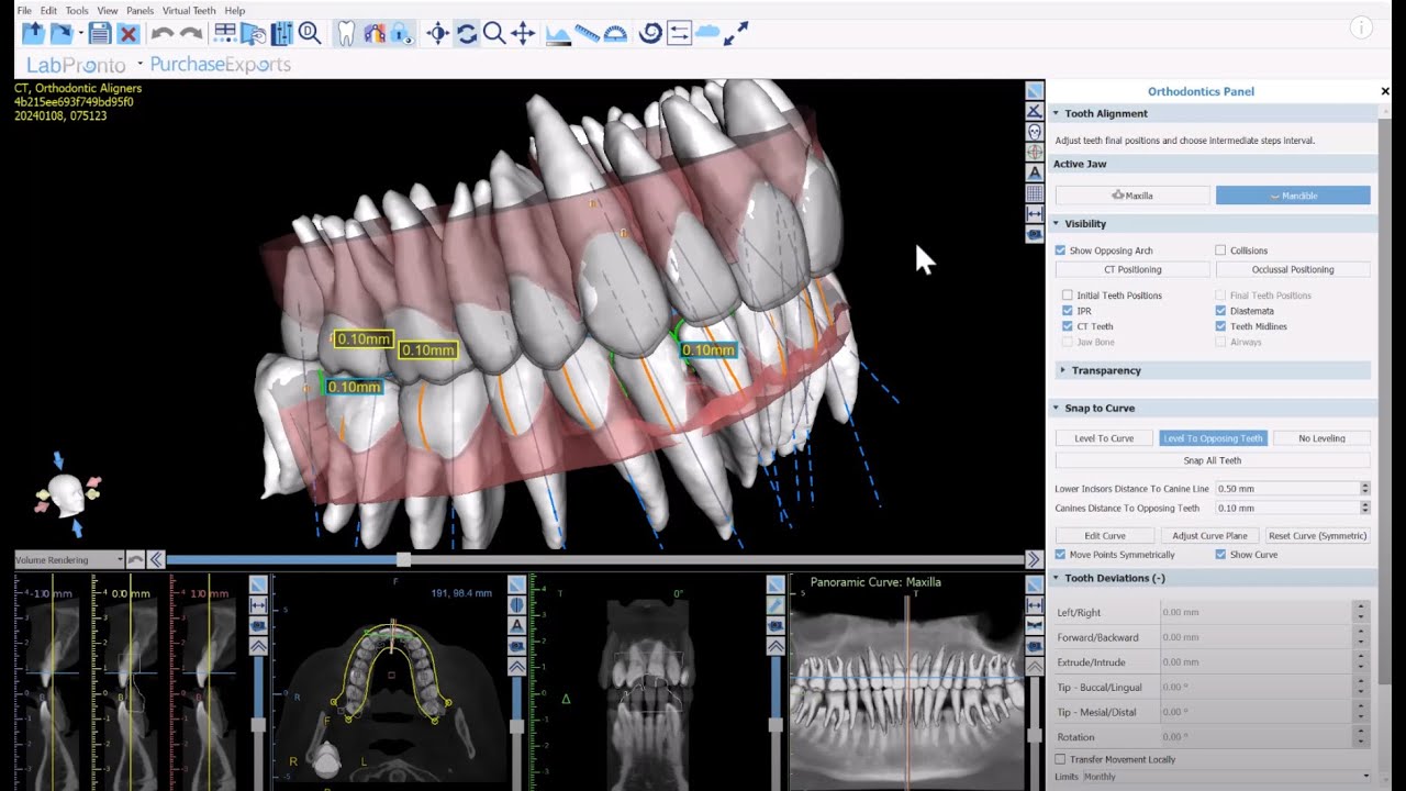 BSP V4.13: Loading and Segmenting Data for Aligner Digital Design with True Anatomical Movements