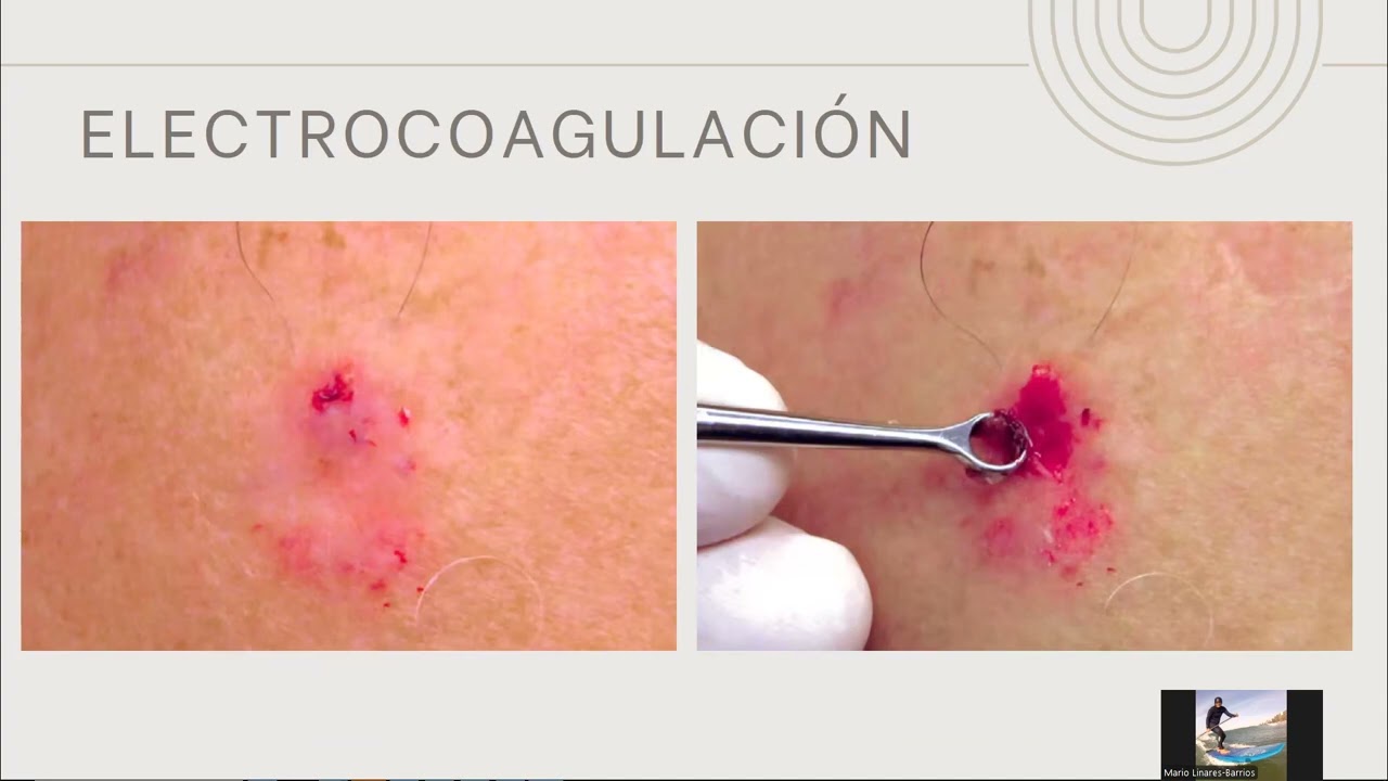 ELECTROCIRUGIA