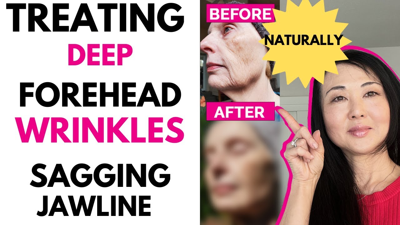 Treating Deep Forehead Lines and Sagging Jawline  #goseechristy