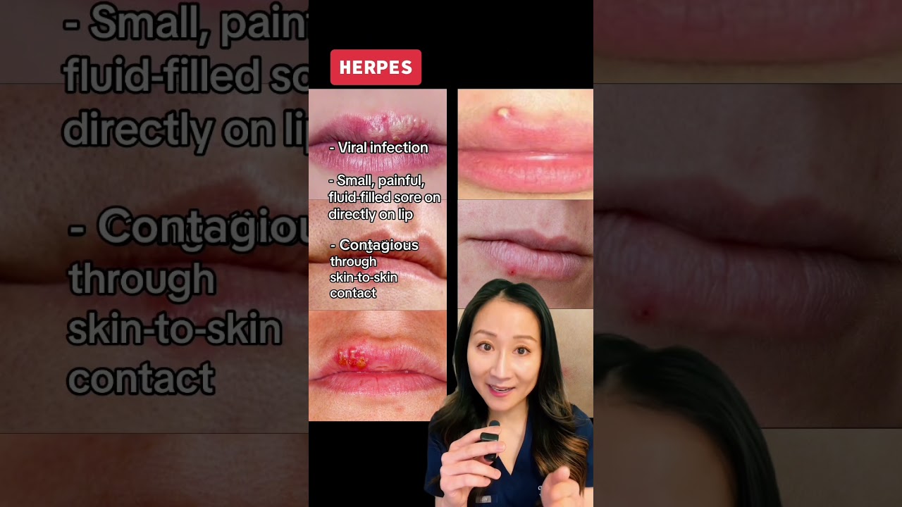 #dermatologist #skincaretips #acnetips #herpesvirus #skintips #shorts #dermatology