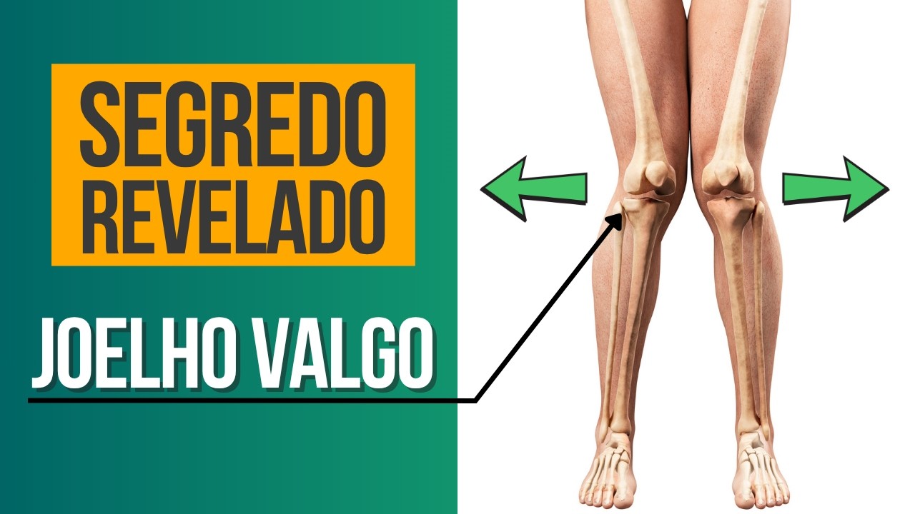 4 Exercícios para ALINHAR O JOELHO Em Casa – Joelho valgo
