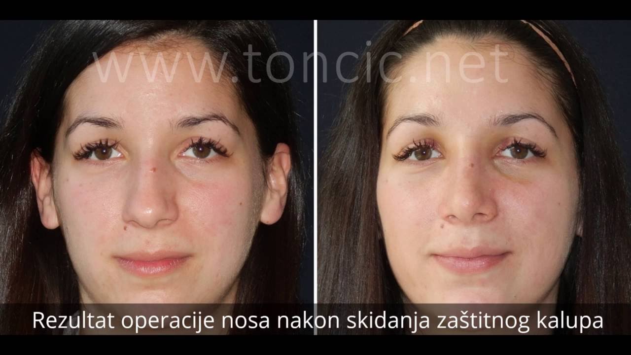 Iskustvo pacijentice s operacijom nosa u Poliklinici dr. Tončić