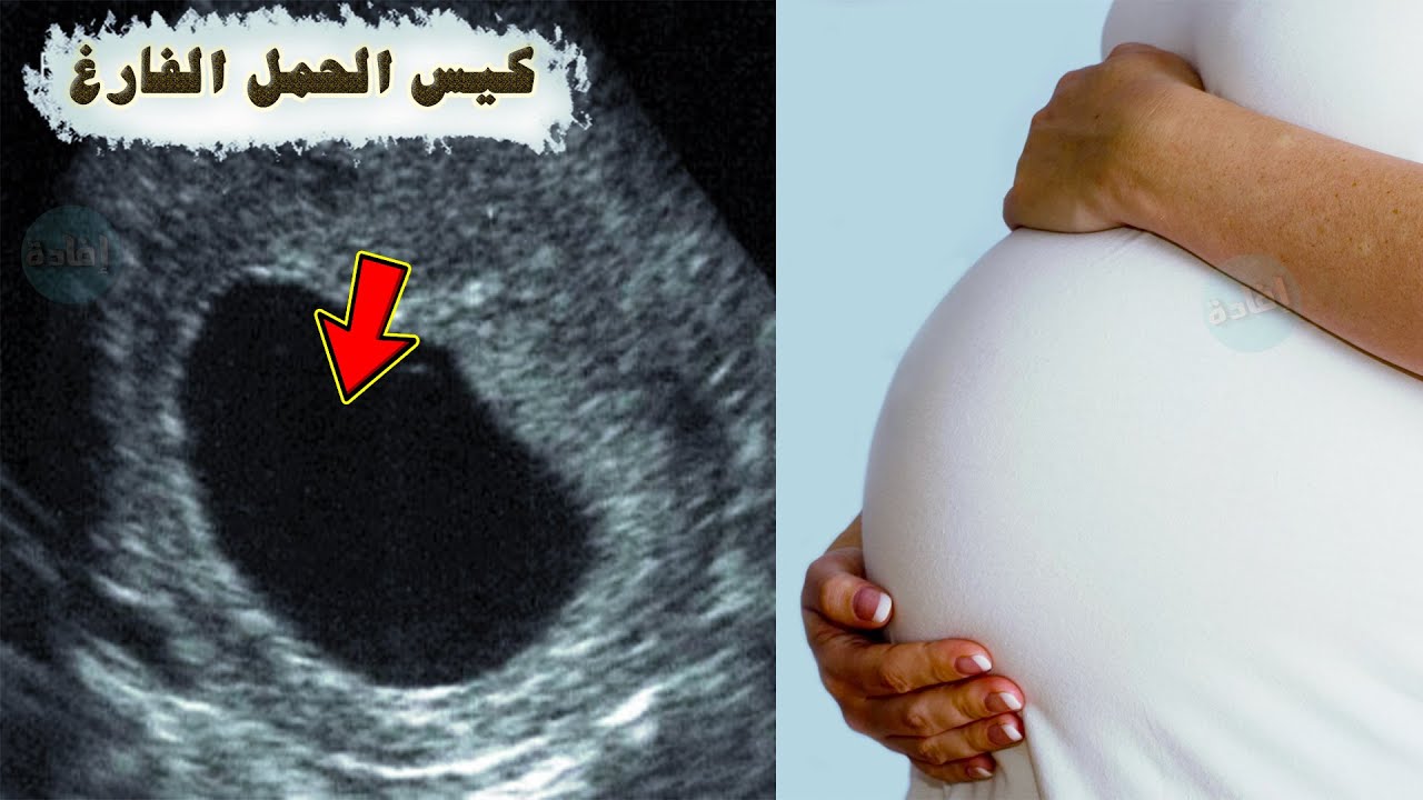 أعراض كيس الحمل الفارغ، ومتى ينزل ؟