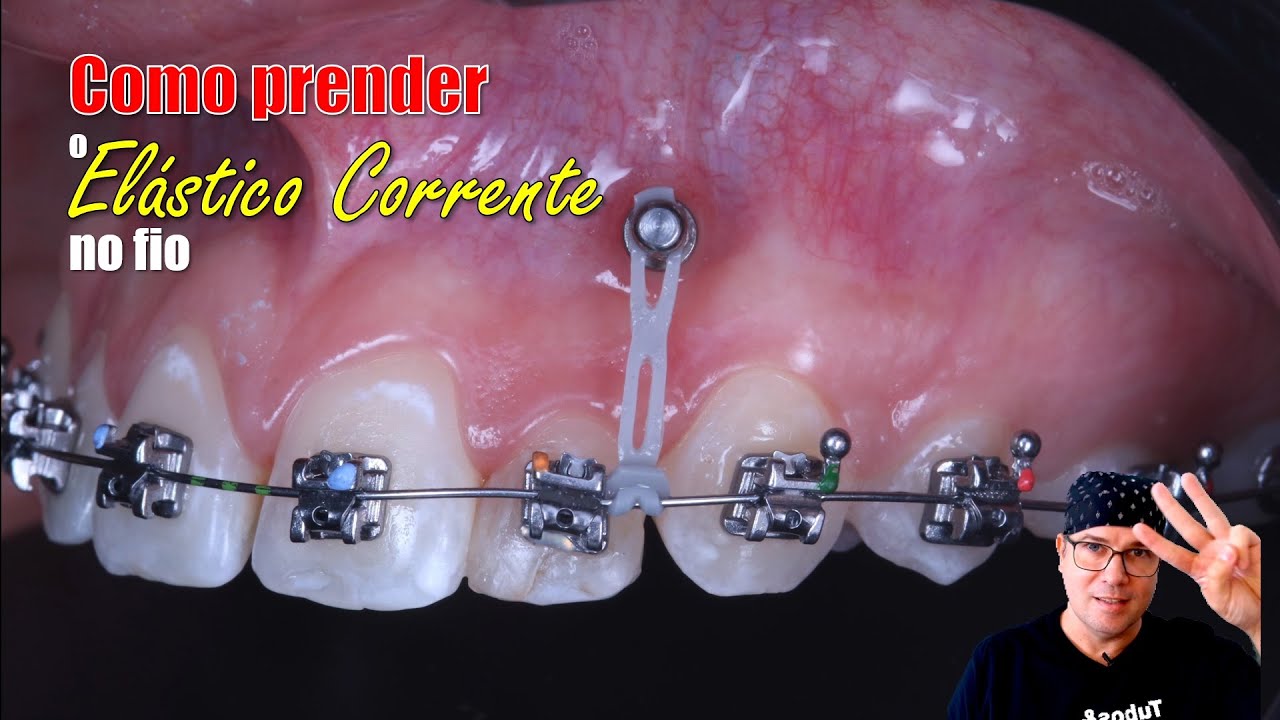 Como prender o Elástico corrente no fio ortodontico