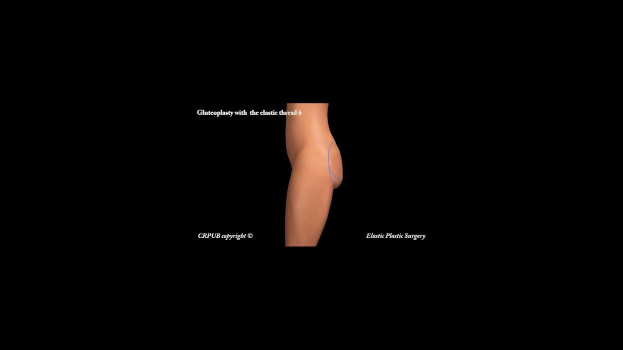 D&Eacute;MONSTRATION GLUTOPLASTIE ELASTICUM